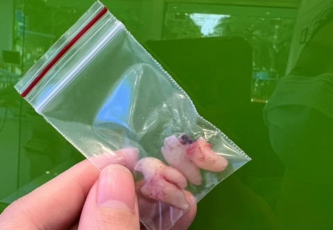 Nhổ răng khôn có ảnh hưởng gì không, có đau không